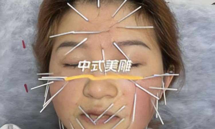 针灸美雕美容体雕正规培训